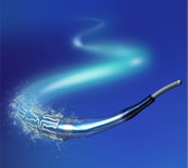 Tư vấn stent phủ thuốc Xience V