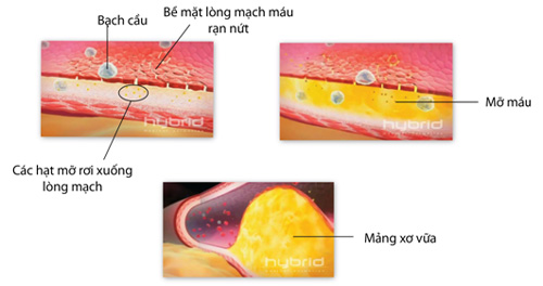 Nguyên nhân hàng đầu gây tử vong và tàn tật là do huyết áp cao