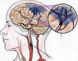 Tiểu đường và tai biến mạch máu não